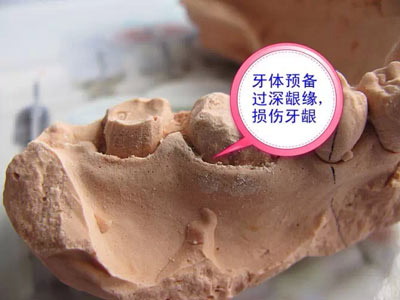 備牙應(yīng)注意的事項(xiàng)+備牙取摸損傷牙齦問題