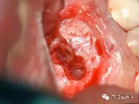 根尖切除術(shù)操作全過(guò)程