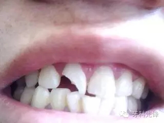 拔牙斷根了怎么辦？