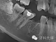 拔牙斷根了怎么辦？