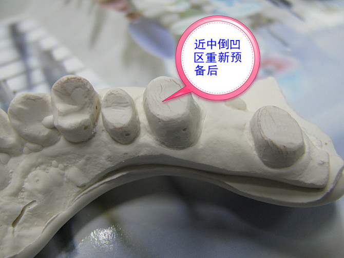 口腔修復(fù)醫(yī)生備牙取摸常見(jiàn)問(wèn)題系列之——基牙倒凹 與 備牙時(shí)“就位道”的處理