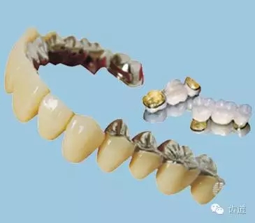 為何烤瓷牙的價(jià)格從幾百元至數(shù)千元不等？告訴您11種烤瓷牙的特點(diǎn)、價(jià)格及優(yōu)缺點(diǎn)