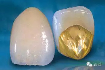 為何烤瓷牙的價(jià)格從幾百元至數(shù)千元不等？告訴您11種烤瓷牙的特點(diǎn)、價(jià)格及優(yōu)缺點(diǎn)