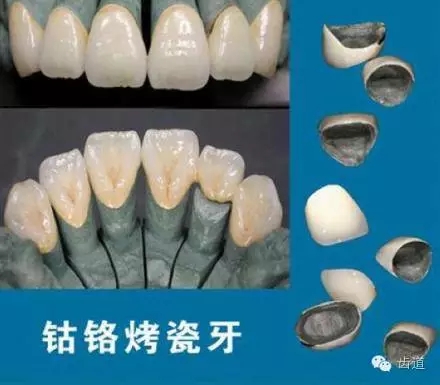 為何烤瓷牙的價(jià)格從幾百元至數(shù)千元不等？告訴您11種烤瓷牙的特點(diǎn)、價(jià)格及優(yōu)缺點(diǎn)