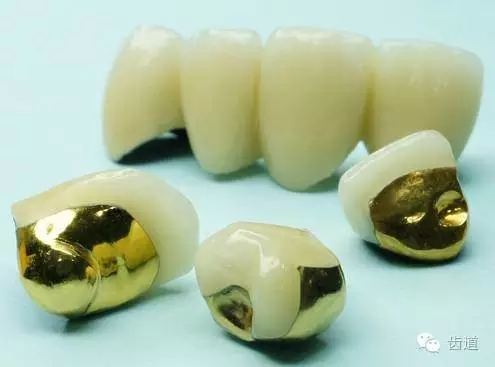 為何烤瓷牙的價(jià)格從幾百元至數(shù)千元不等？告訴您11種烤瓷牙的特點(diǎn)、價(jià)格及優(yōu)缺點(diǎn)
