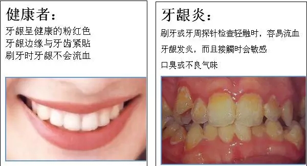 【科普】牙周病的預(yù)防和治療