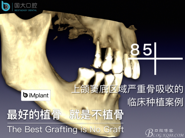 上頜竇底區(qū)域嚴重骨吸收的臨床種植案例