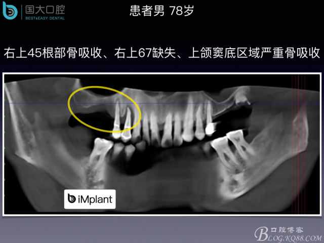 上頜竇底區(qū)域嚴重骨吸收的臨床種植案例.jpeg