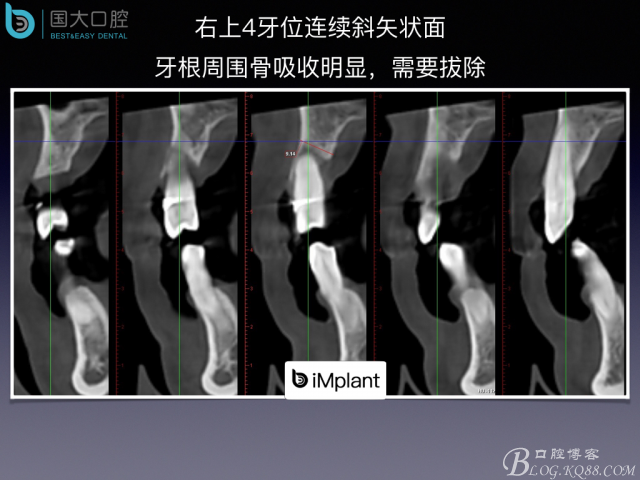 上頜竇底區(qū)域嚴重骨吸收的臨床種植案例.jpeg