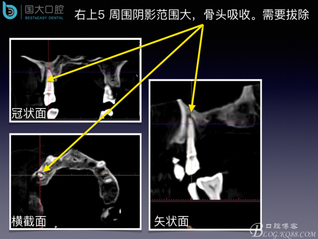 上頜竇底區(qū)域嚴重骨吸收的臨床種植案例.jpeg