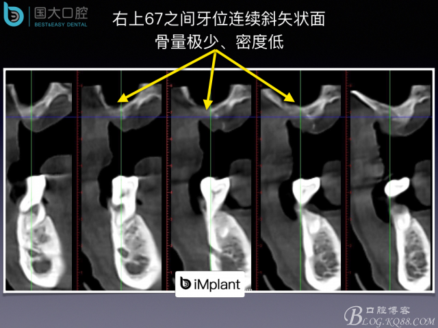 上頜竇底區(qū)域嚴重骨吸收的臨床種植案例.jpeg