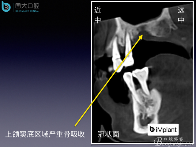 上頜竇底區(qū)域嚴重骨吸收的臨床種植案例.jpeg