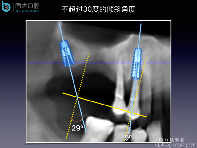 上頜竇底區(qū)域嚴重骨吸收的臨床種植案例.jpeg