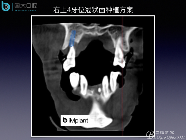 上頜竇底區(qū)域嚴重骨吸收的臨床種植案例.jpeg
