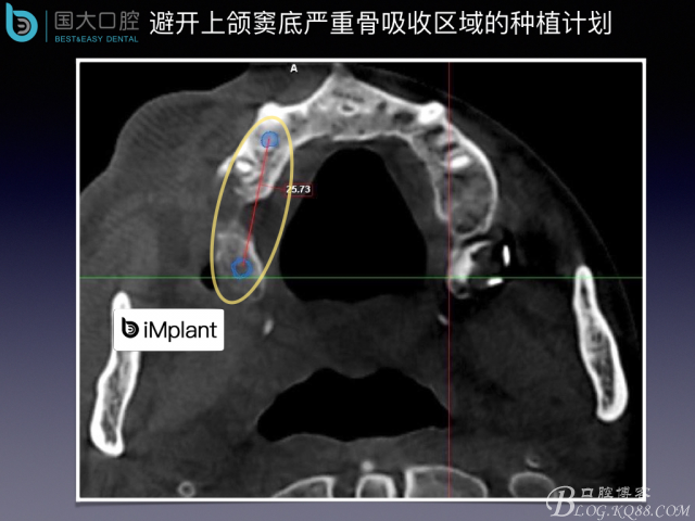 上頜竇底區(qū)域嚴重骨吸收的臨床種植案例.jpeg