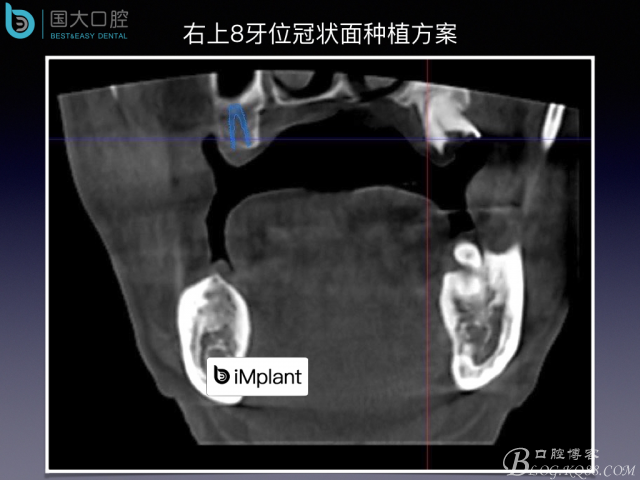 上頜竇底區(qū)域嚴重骨吸收的臨床種植案例.jpeg