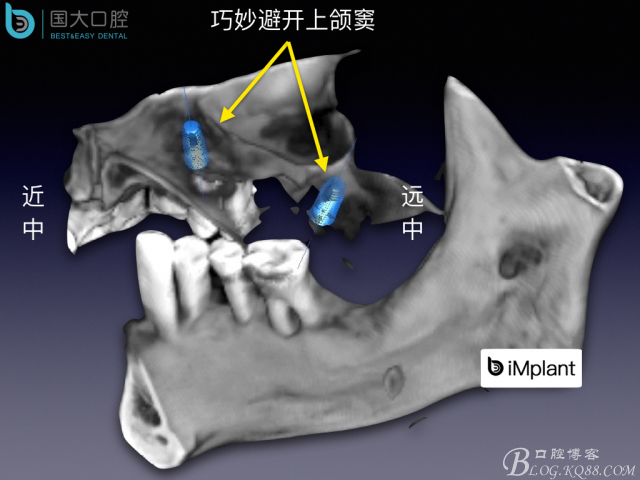 上頜竇底區(qū)域嚴重骨吸收的臨床種植案例.jpeg