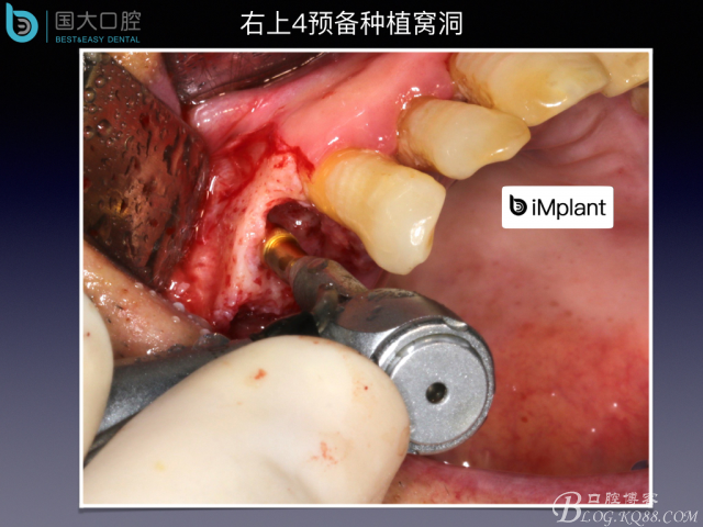 上頜竇底區(qū)域嚴重骨吸收的臨床種植案例.jpeg