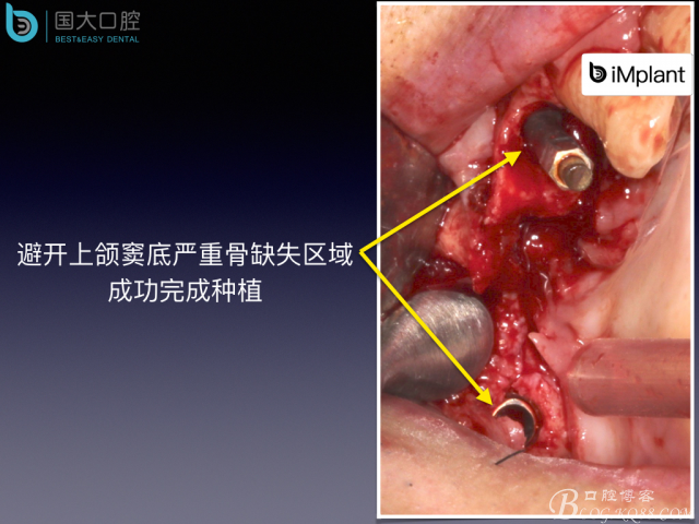 上頜竇底區(qū)域嚴重骨吸收的臨床種植案例.jpeg