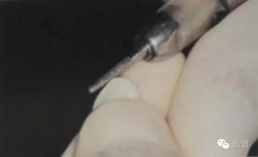 瓷貼面的粘接步驟及技術(shù)要點