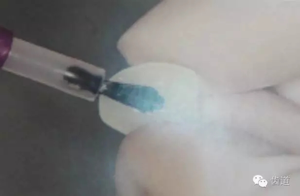 瓷貼面的粘接步驟及技術(shù)要點