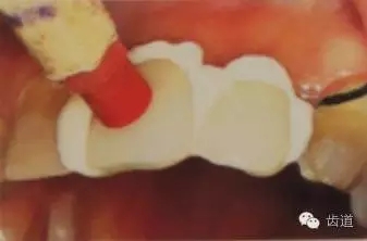 瓷貼面的粘接步驟及技術(shù)要點