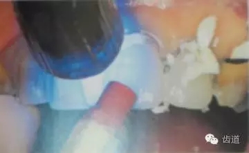 瓷貼面的粘接步驟及技術(shù)要點