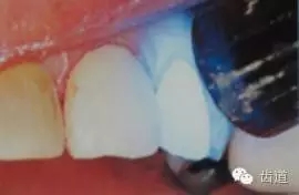 瓷貼面的粘接步驟及技術(shù)要點