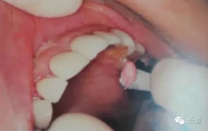 瓷貼面的粘接步驟及技術(shù)要點