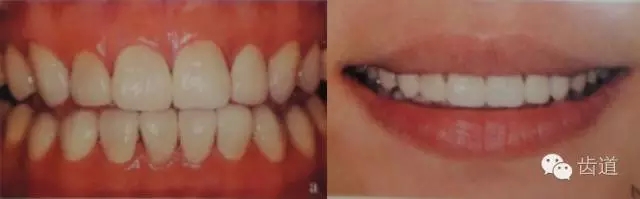 瓷貼面的粘接步驟及技術(shù)要點