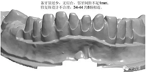 影響全瓷牙冠裂的因素有哪些？