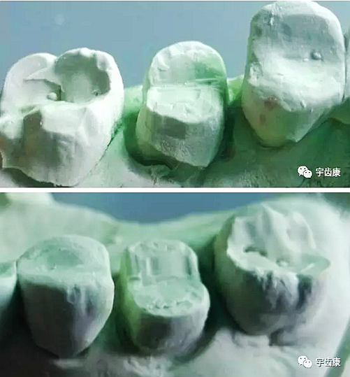 影響全瓷牙冠裂的因素有哪些？