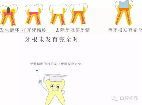【愛(ài)牙科普知識(shí)300問(wèn)】 “什么是活髓切斷術(shù)？”
