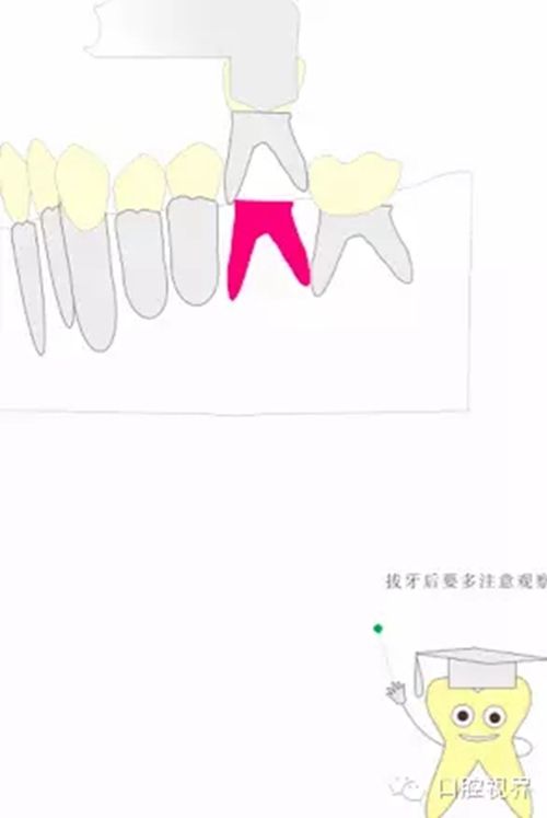 【愛(ài)牙科普知識(shí)300問(wèn)】 “什么是活髓切斷術(shù)？”