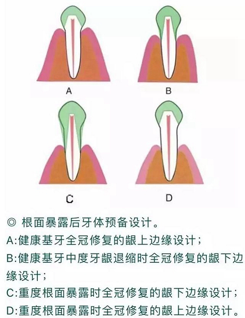 做全冠修復(fù)時基牙根面暴露，如何備牙？