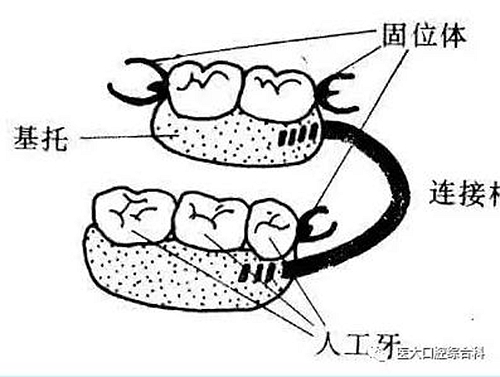 醫(yī)大口腔綜合科 |“鑲牙”的學(xué)問(wèn)——活動(dòng)類 