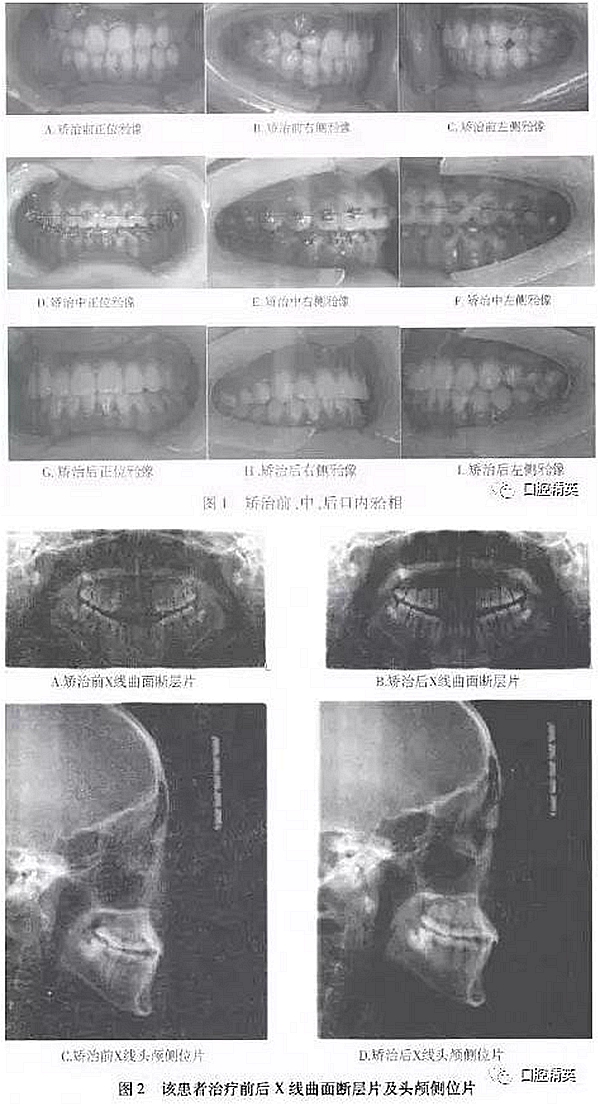 尖牙完全唇側(cè)錯(cuò)位擁擠，矯正1例  