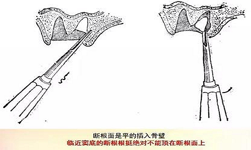 拔牙斷根的去與留？