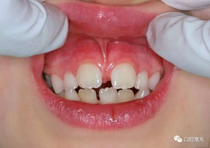 【案例】口腔激光輔助兒童口腔系帶整形概述在兒童口腔治療中，最大的挑戰(zhàn)就是兒童對疼痛、治療器械、噪聲以及其他所有陌生事物的恐懼心理。