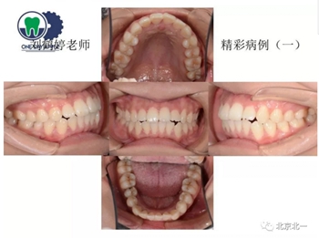 多學(xué)科病例分析---正畸、種植、微創(chuàng)拔牙多學(xué)科交叉病例