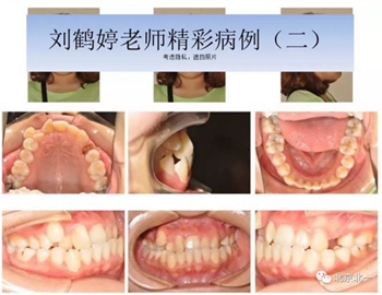 多學(xué)科病例分析---正畸、種植、微創(chuàng)拔牙多學(xué)科交叉病例