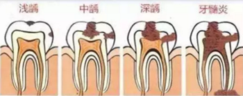 當心“腹黑”齲齒，牙齒有個小洞也要補！