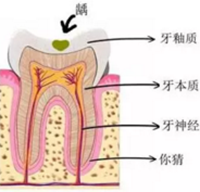 當心“腹黑”齲齒，牙齒有個小洞也要補！