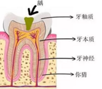 當心“腹黑”齲齒，牙齒有個小洞也要補！