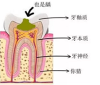 當心“腹黑”齲齒，牙齒有個小洞也要補！