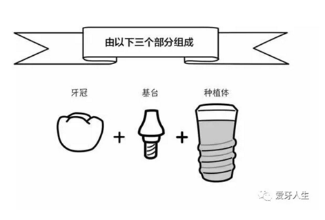 如何選擇種植牙，給《患者》推薦這篇文章就足矣