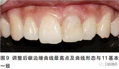 前牙即刻種植并個性化基臺美學(xué)修復(fù)