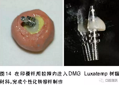 前牙即刻種植并個性化基臺美學(xué)修復(fù)