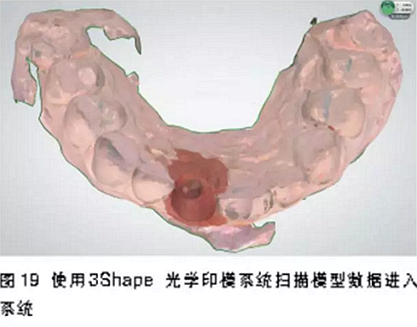 前牙即刻種植并個性化基臺美學(xué)修復(fù)