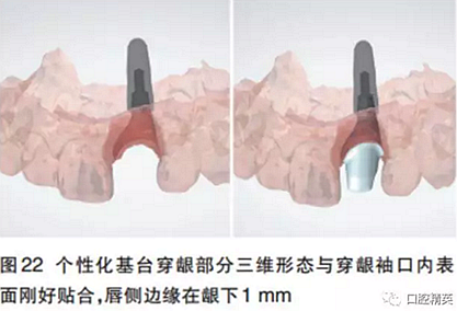 前牙即刻種植并個性化基臺美學(xué)修復(fù)